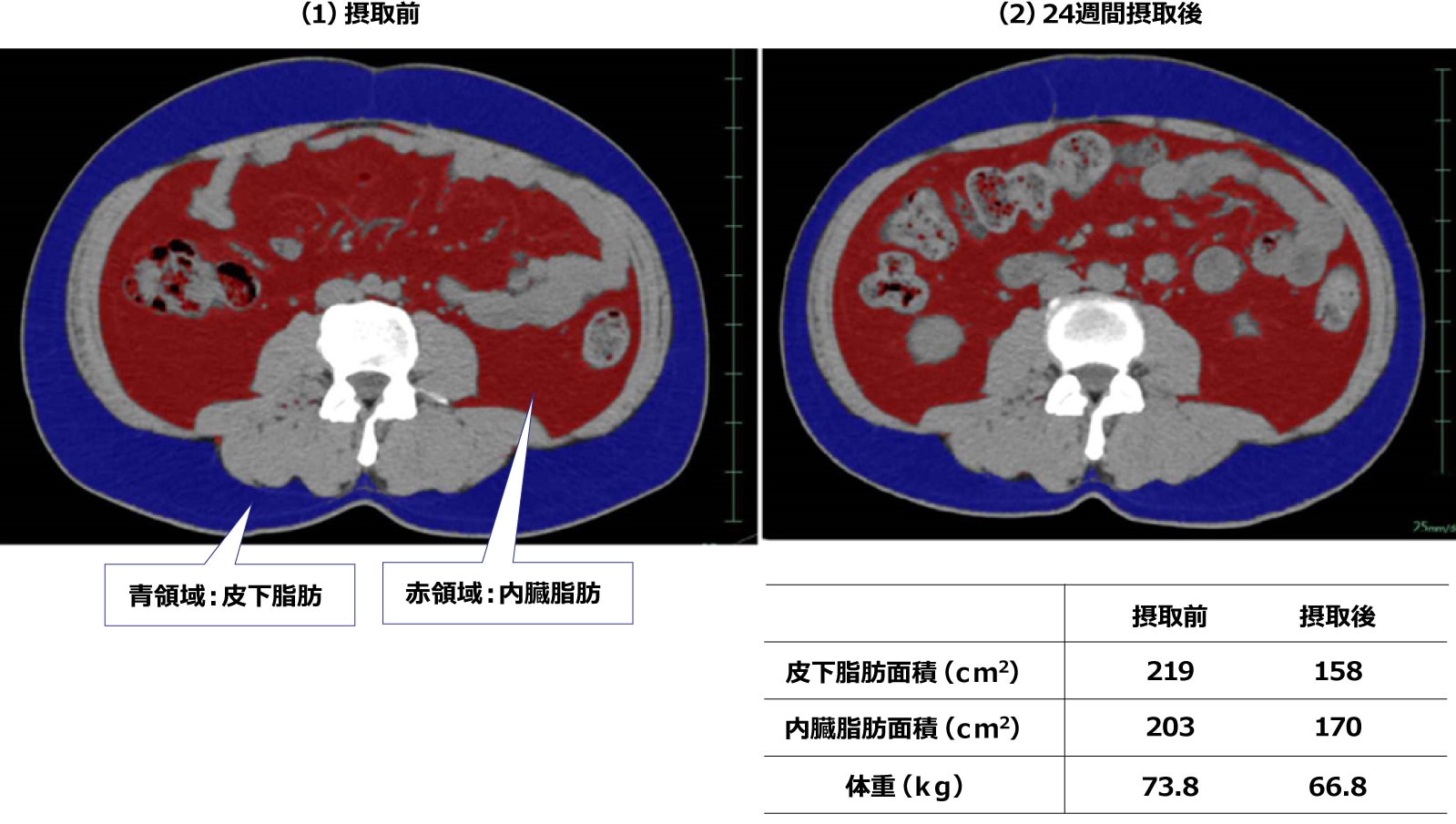 ビフィズス菌製剤を摂取していた方の腹部CT画像